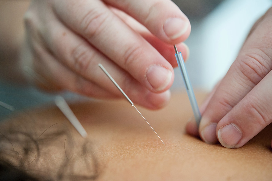 Akupunktur ist Teil der chinesischen Medizin darauf beruht Wirkung der Nagelmatte